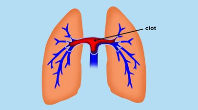 saddle-pulmonary-embolism